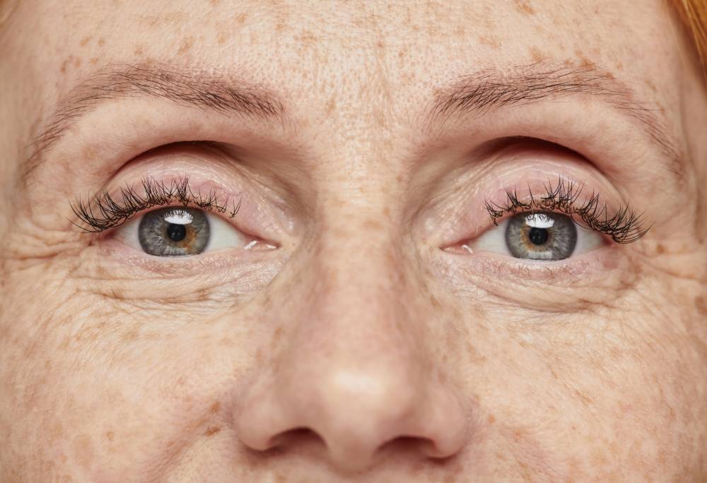 Blefaritis y su relación con el ojo seco: causas y tratamientos